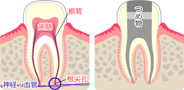 健康な奥歯と抜髄処置・根幹治療後の奥歯