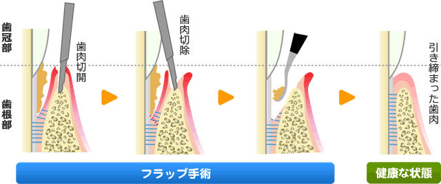 歯周外科治療：フラップ手術（歯肉剥離掻爬術）