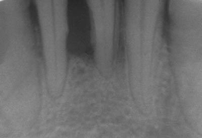 歯周基本検査：レントゲン検査（Photo: Bernard Bill5 via Wikipedia, http://en.wikipedia.org/wiki/File:Paro1.JPG）