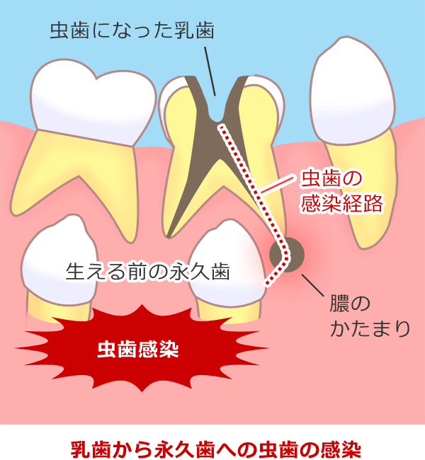 乳歯から永久歯への虫歯の感染経路
