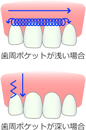 歯科レーザー歯周治療で歯周組織を効果的に殺菌・消毒