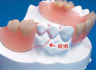 レイニング樹脂Ｎの部分入れ歯は歯を増やしたり破損補修できます