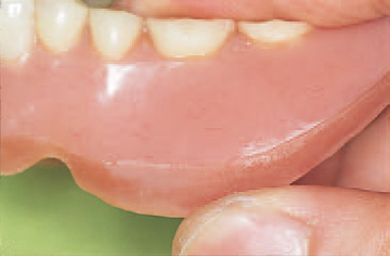 シリコーン義歯の２年８カ月経過の臨床結果