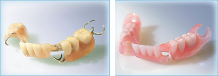 金属床義歯とバルプラストの比較
