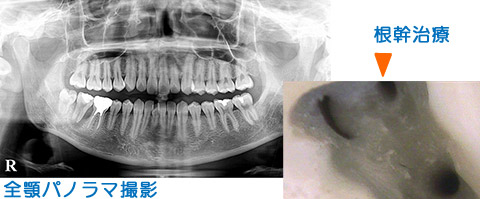 歯科用CT・デジタルレントゲン撮影システム、全顎パノラマ撮影、根幹治療用CT画像