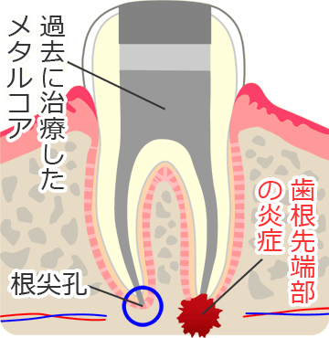 根尖性歯周炎（歯根膜炎）