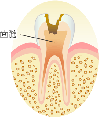 Ｃ３ ： 歯の神経（歯髄）の虫歯