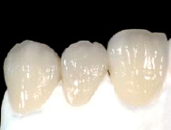 オールセラミックスによる前歯部３本ブリッジ