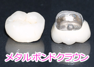 奥歯（臼歯）のメタルボンドクラウン