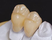 小臼歯の保険適用のCAD/CAM冠