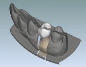 人工歯を専用ソフトで設計（CAD）